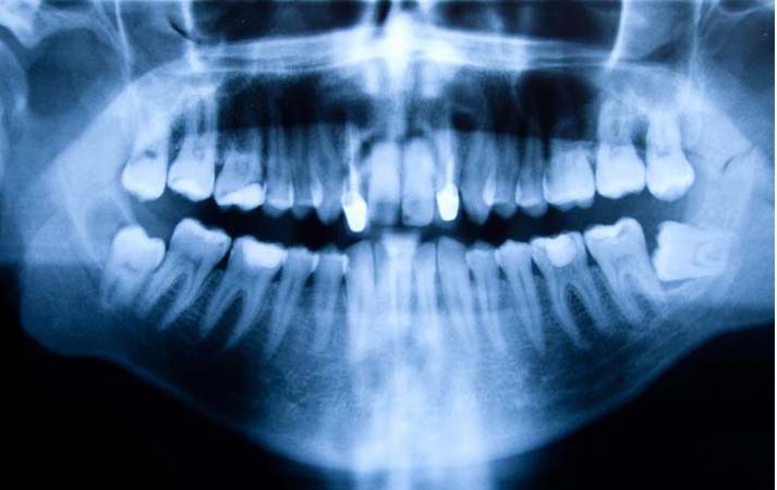 Panoramic mouth x-ray