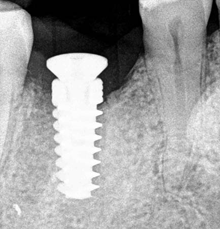X-ray of post screwed into my jaw