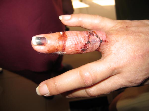 Akaisha's finger after necrosis removed, after skin graft. Still swollen from fracture